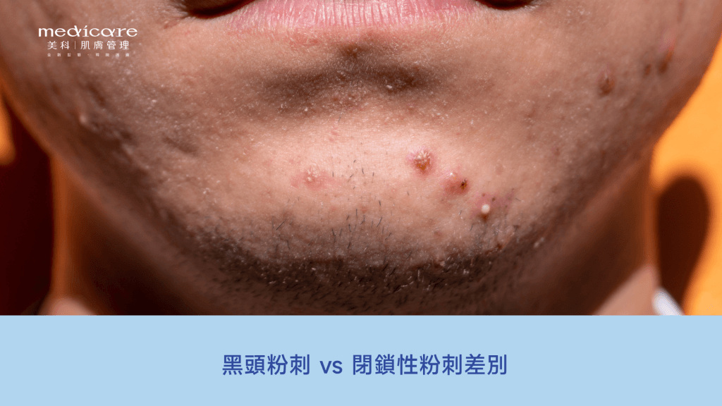 黑頭粉刺與閉鎖性粉刺的差別