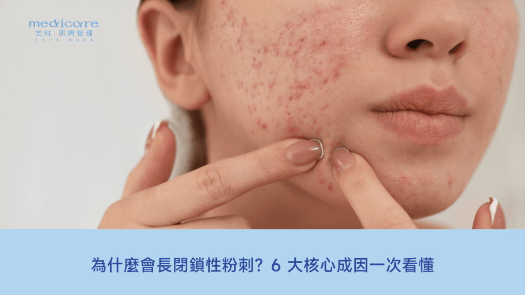 為什麼會長閉鎖性粉刺