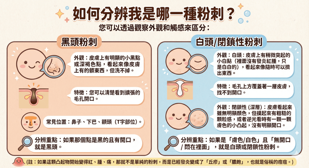 如何分辨我是哪一種粉刺?