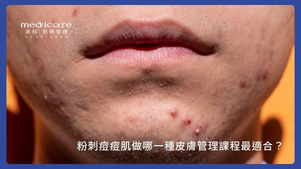 粉刺痘痘肌做哪一種皮膚管理課程最適合?