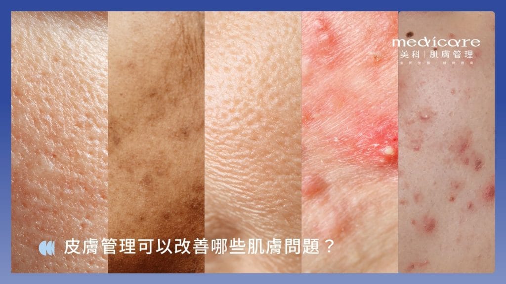 皮膚管理可以改善哪些肌膚問題?