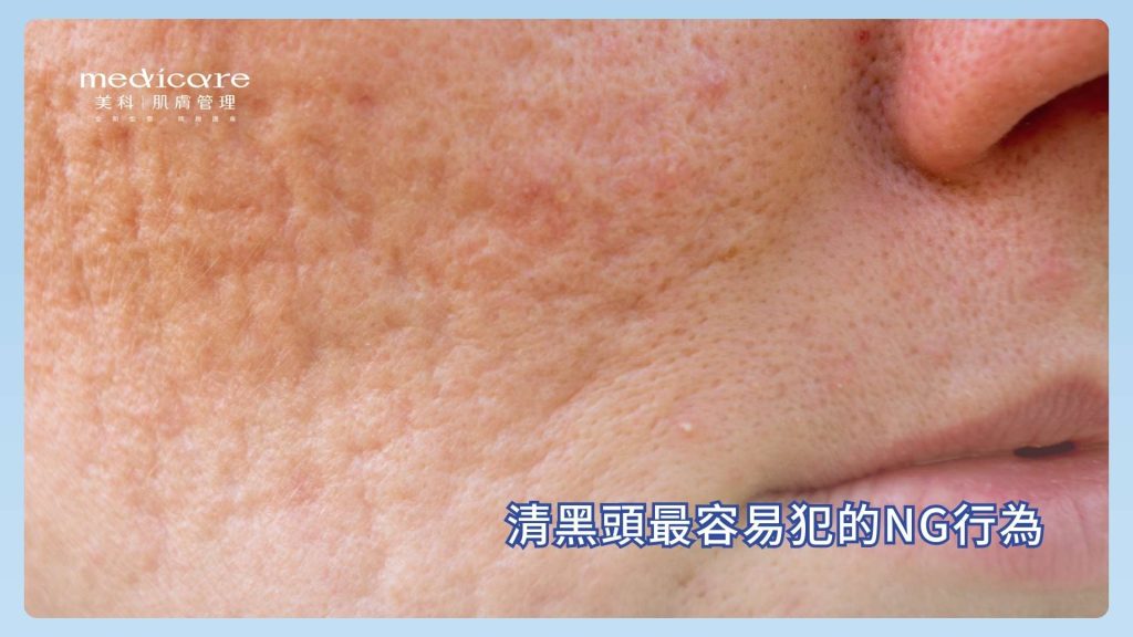 清黑頭最容易犯的NG行為