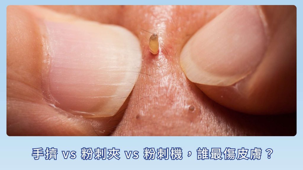 手擠 vs 粉刺夾 vs 粉刺機,誰最傷皮膚?