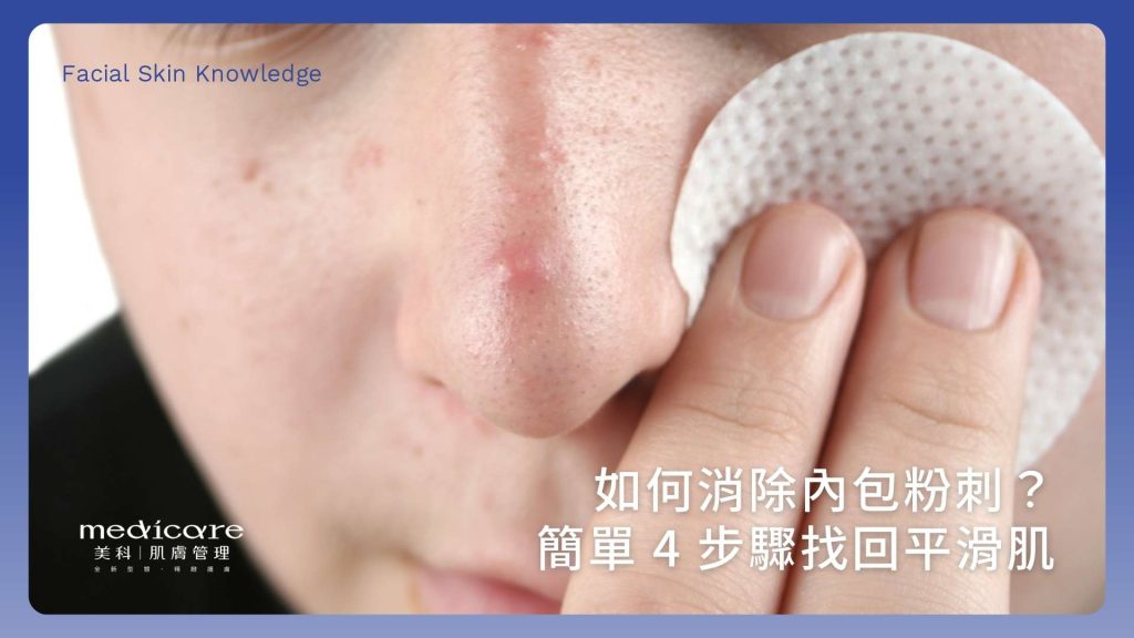 如何消除內包粉刺?