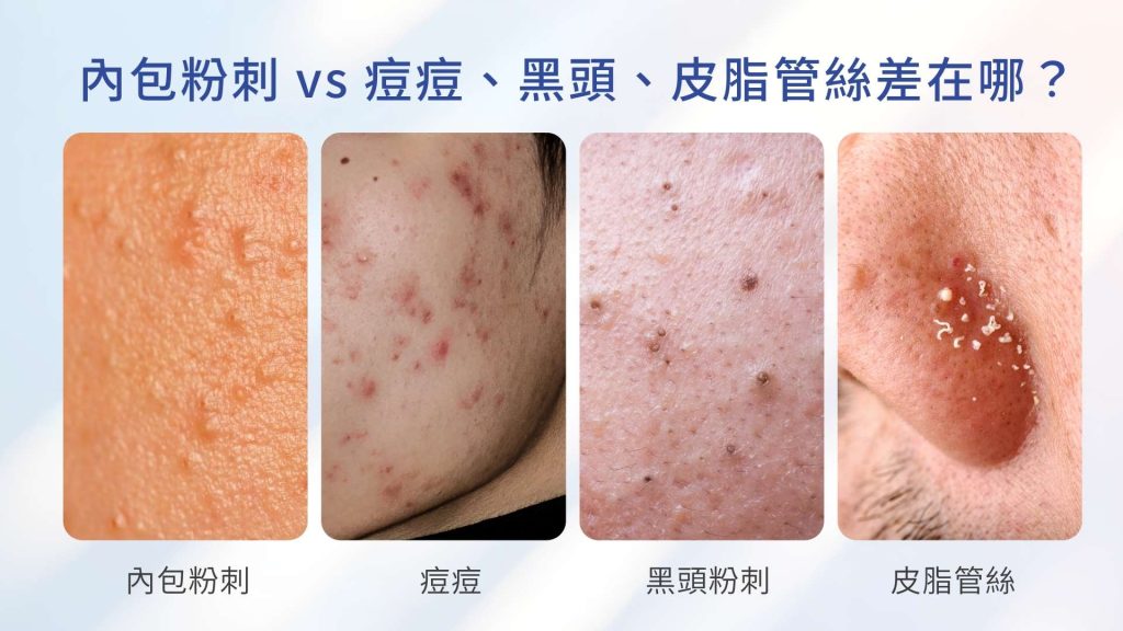 3 秒分辨:內包粉刺 vs 痘痘、黑頭、皮脂管絲差在哪?