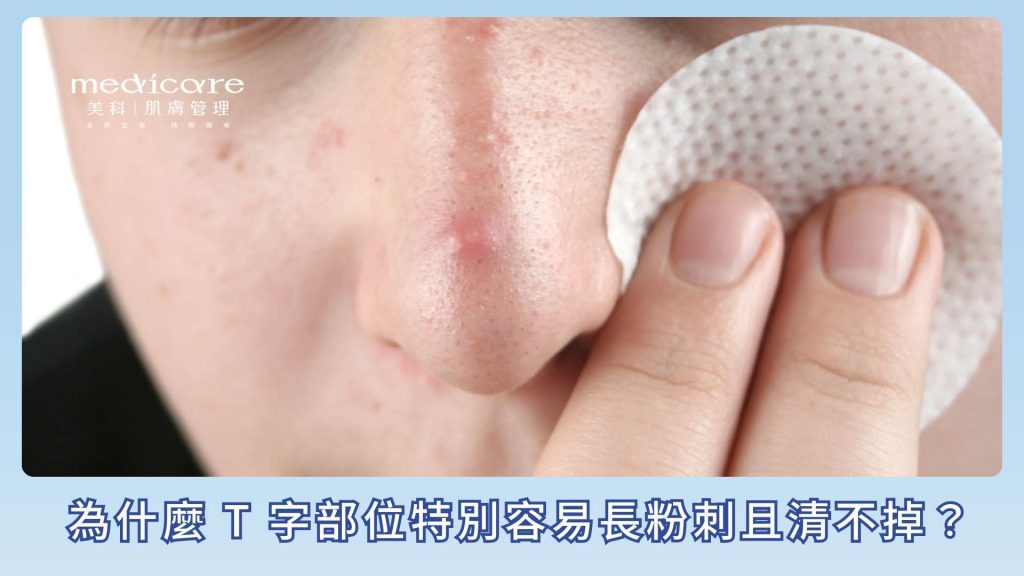 為什麼 T 字部位特別容易長粉刺且清不掉?