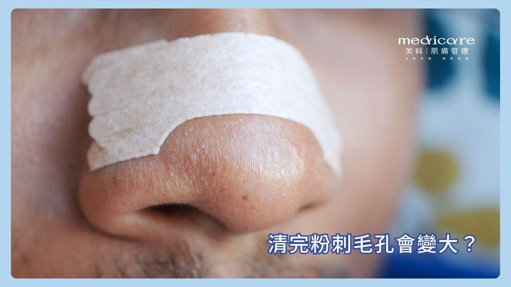 清完粉刺毛孔會變大?