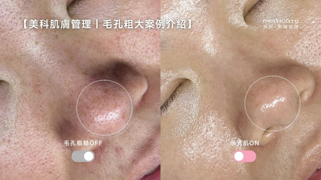 美科肌膚管理毛孔粗大案例介紹