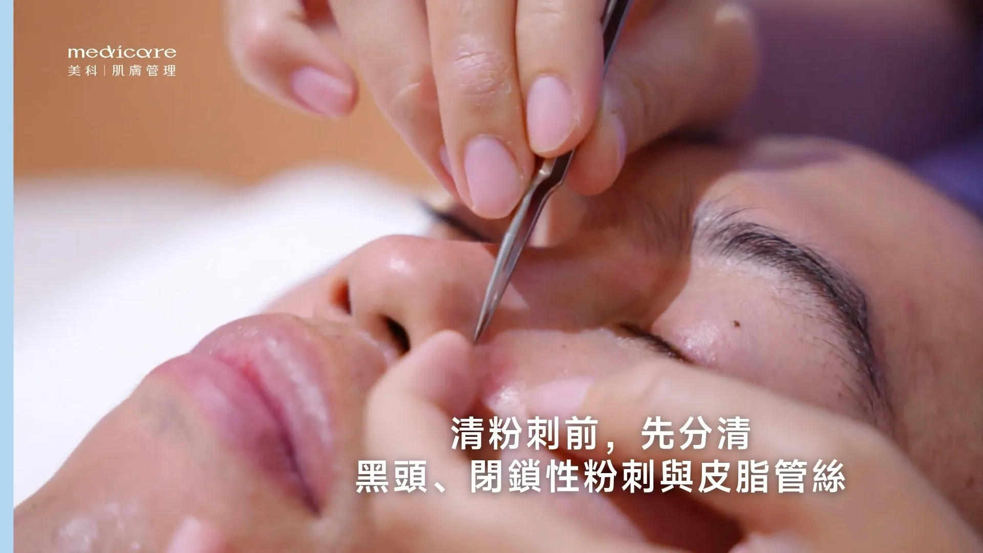 清粉刺前先分清黑頭、閉鎖性粉刺與皮脂管絲