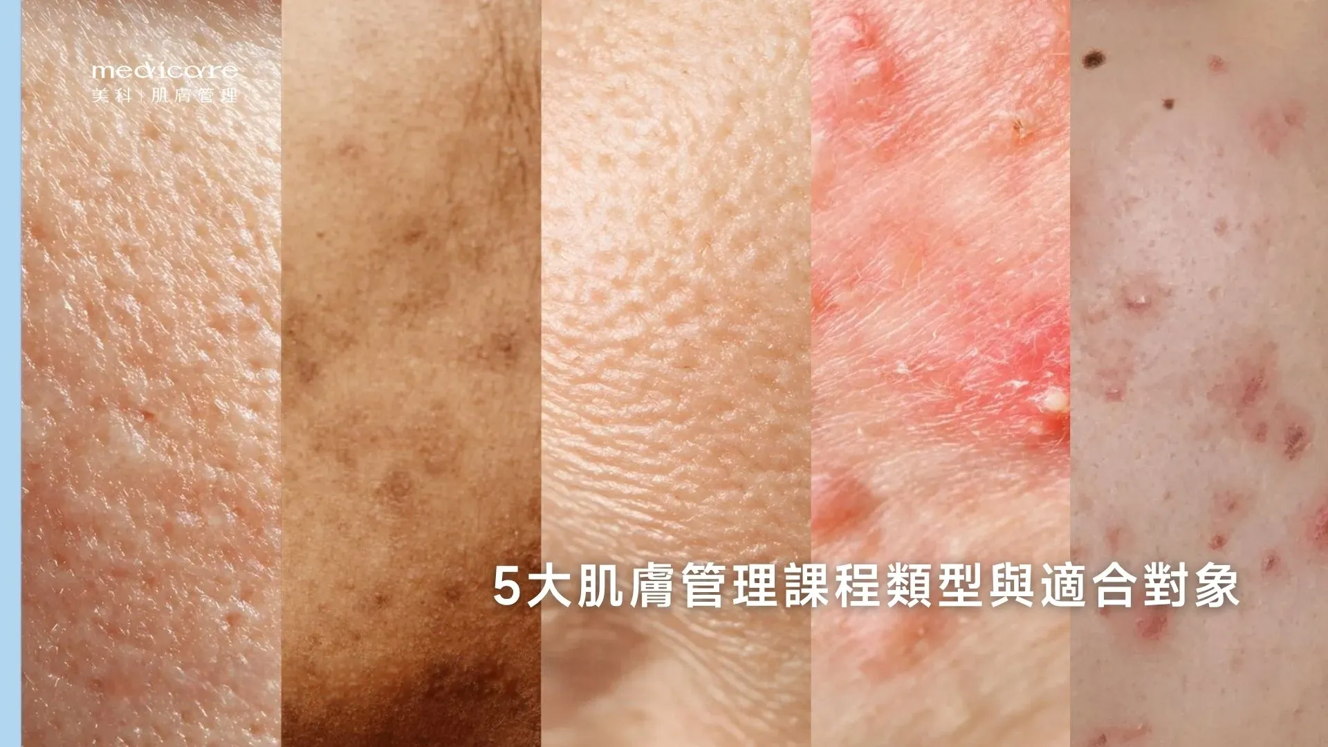 5大肌膚管理課程類型與適合對象