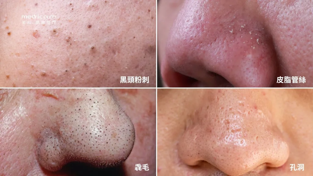 分辨粉刺、皮脂管絲、毳毛、孔洞