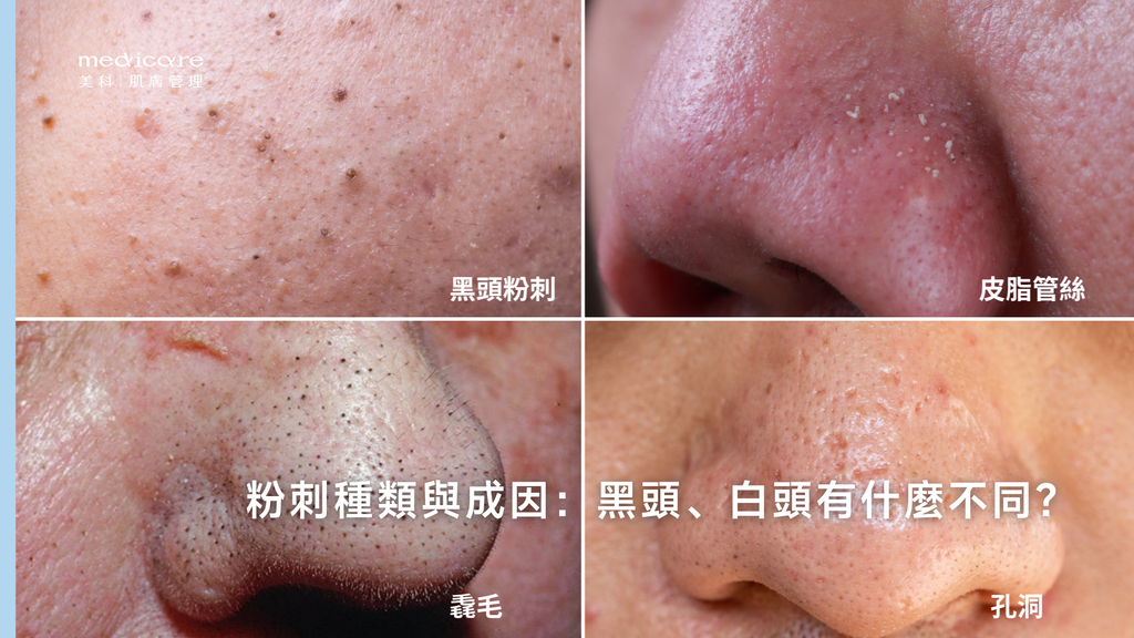 粉刺種類與成因:黑頭、白頭有什麼不同?