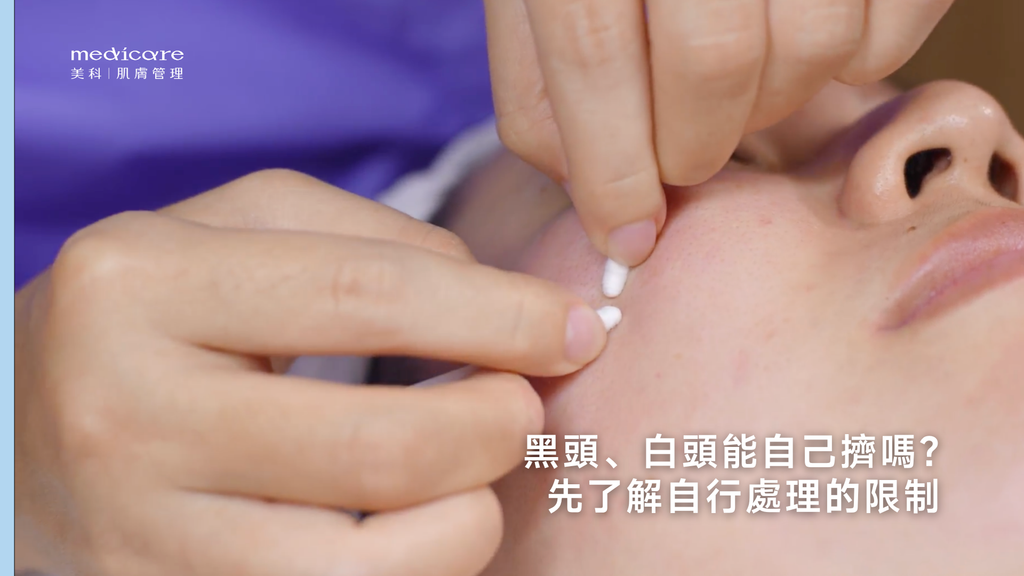 黑頭、白頭能自己擠嗎?先了解自行處理的限制