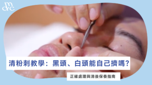 清粉刺教學：黑頭、白頭能自己擠嗎？正確處理與清後保養指南